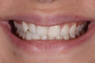 Before - Figges Marsh Dental