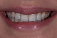 After - Figges Marsh Dental