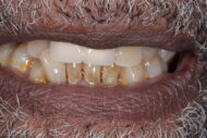 Before - Figges Marsh Dental