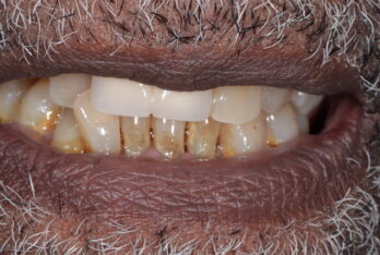 Before - Figges Marsh Dental