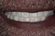 After - Figges Marsh Dental